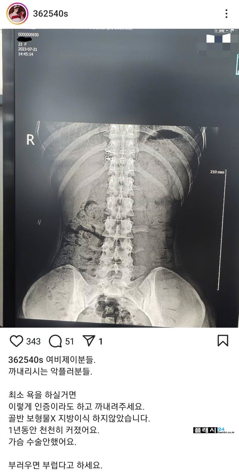 빡쳐서 골반수술 안 했다고 인증하는 누나